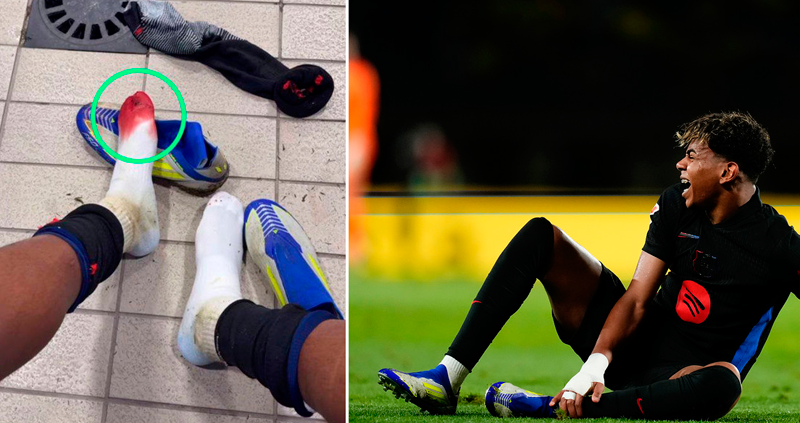 Lamine Yamal muestra su pie sangriento después de un pisoteo en un juego completo
